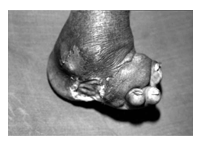 orthopedic diabetic shoes