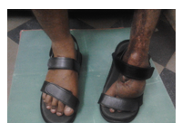 orthopedic diabetic shoes