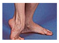 orthopedic diabetic shoes